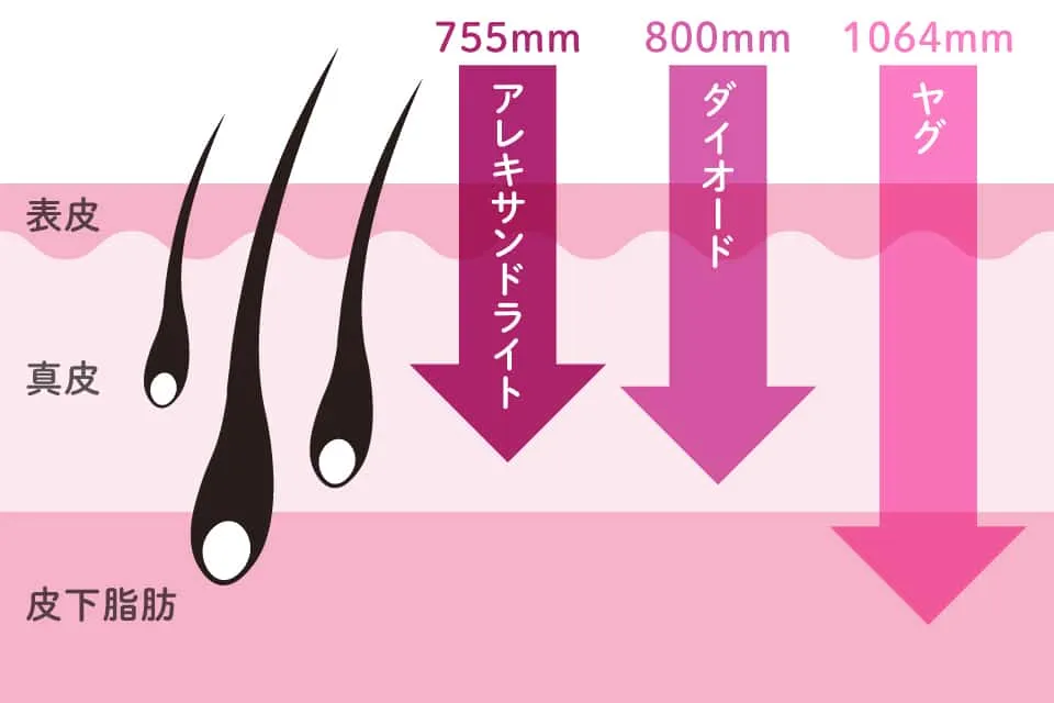 医療脱毛詳細機器の波長の違いについて解説画像
