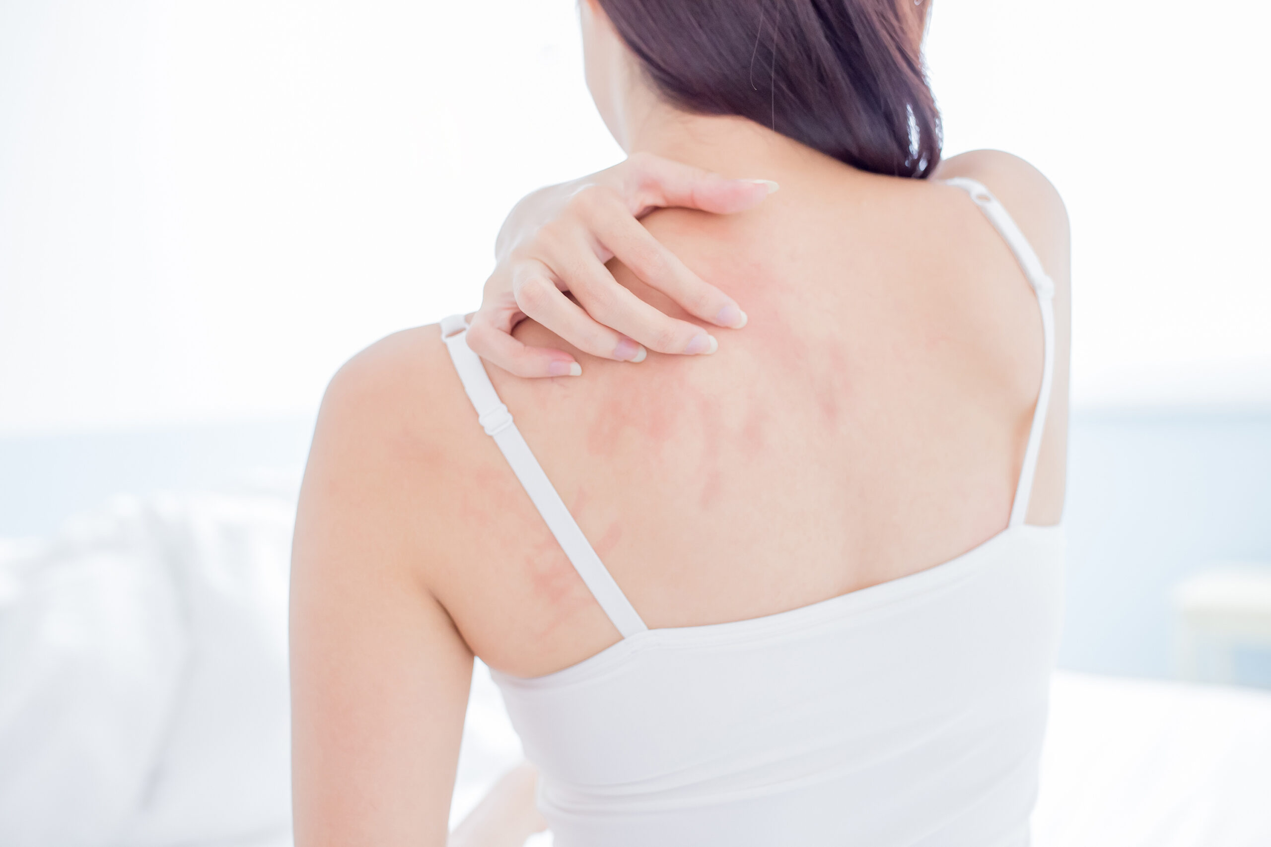 hives